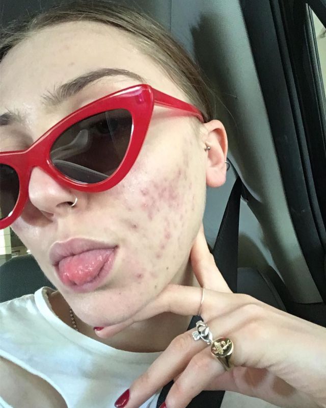 #FreethePimple es el nuevo movimiento de Instagram que tienes que conocer #FreethePimple es el nuevo movimiento de Instagram que tienes que conocer