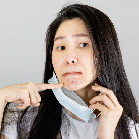 8 trucos para evitar el ‘maskné’, el acné causado por la mascarilla